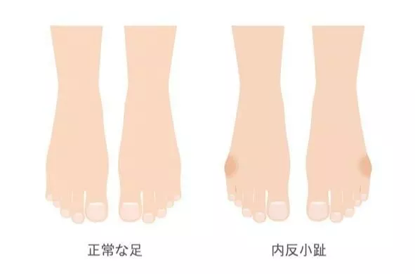 内反小趾